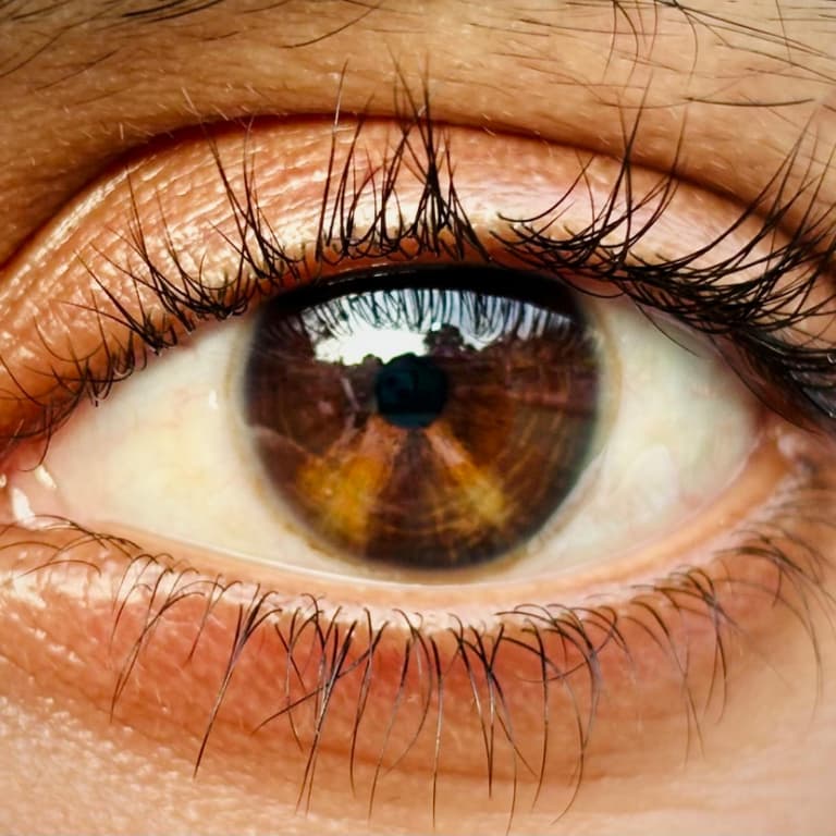 Diabetic Retinopathy