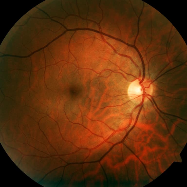 Macular Degeneration