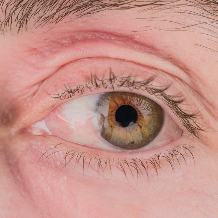 Pterygium