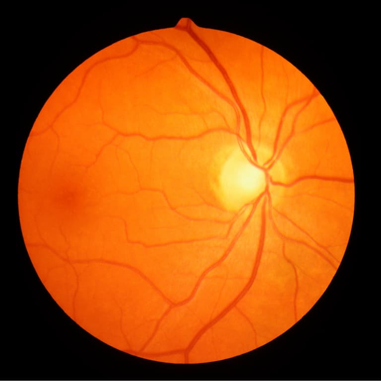 Retina Vein Occlusion